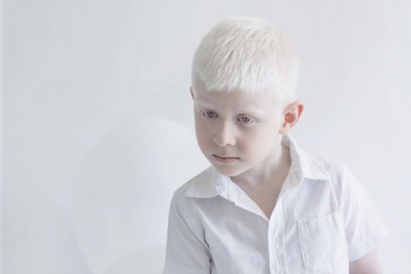 beautiful-albino-people-albinism-13-582ebf0877a24-880-622x415