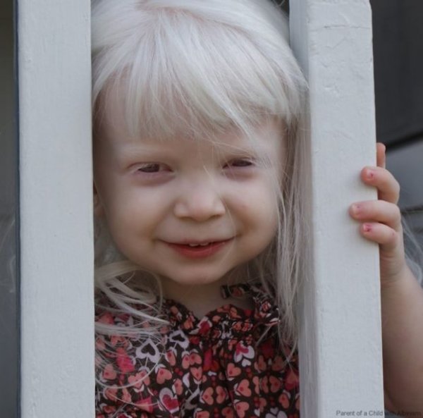 beautiful-albino-people-albinism-14-582f11e46f02c-880-622x615