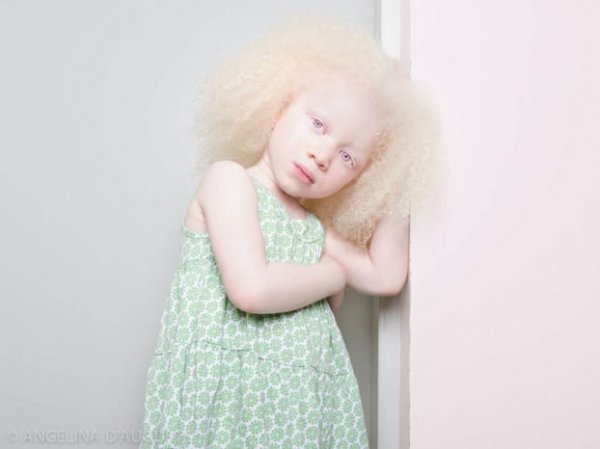 beautiful-albino-people-albinism-51-582f007b2f4b8-880-622x466