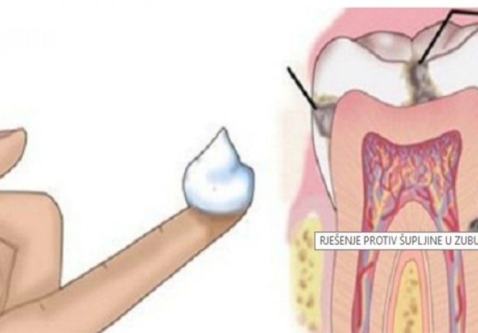 ZABORAVITE NA STOMATOLOGE: Evo kako ćete popuniti zubnu šupljinu od kuće!