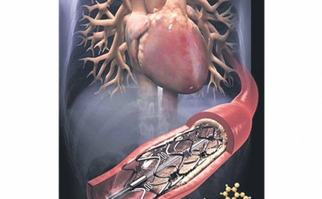 757z468-stent