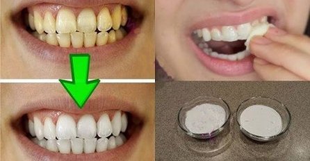 PROVJERENO DJELUJE: Zagarantovano izbjeljivanje zuba za manje od 2 minuta!