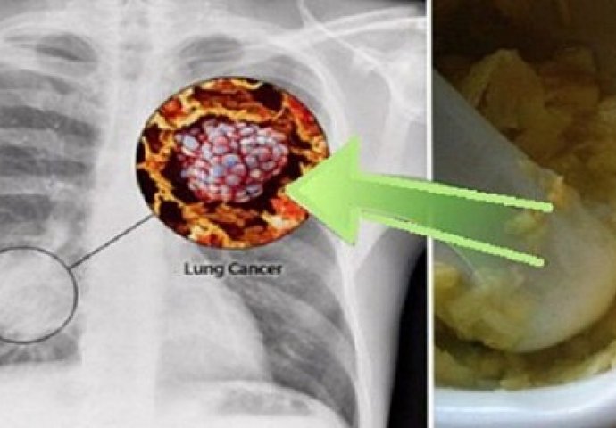  ČUVAR ZDRAVLJA: Pojedite ovu smjesu i istog trenutka spriječite nastanak raka pluća!