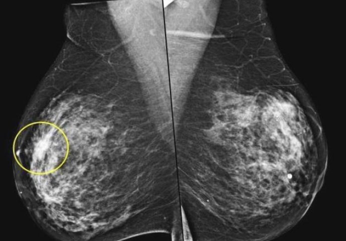 OVO SVAKA ŽENA MORA ZNATI: Ovo je simptom raka dojke koji možete primijetiti sami! (FOTO)