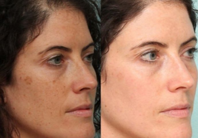  Uklonite tamne fleke sa lica: Za par dana imat ćete kožu kao beba! (RECEPT)