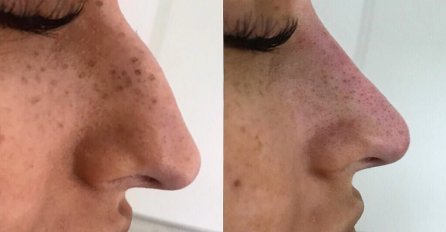 PJEVAČICA OPERISALA NOS PA NJENE FOTKE PROCURILE U JAVNOST: Kažu da je nikad ljepša!