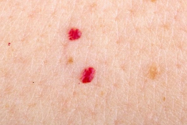 cherry-angioma