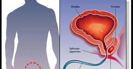 MUŠKARCI OPREZ, OVI SIMPTOMI UKAZUJU NA RAK PROSTATE: Evo kako da prepoznate bolest u začetku!