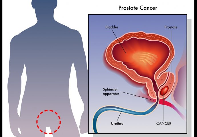 prostate bol zbog karcinoma u zglobu