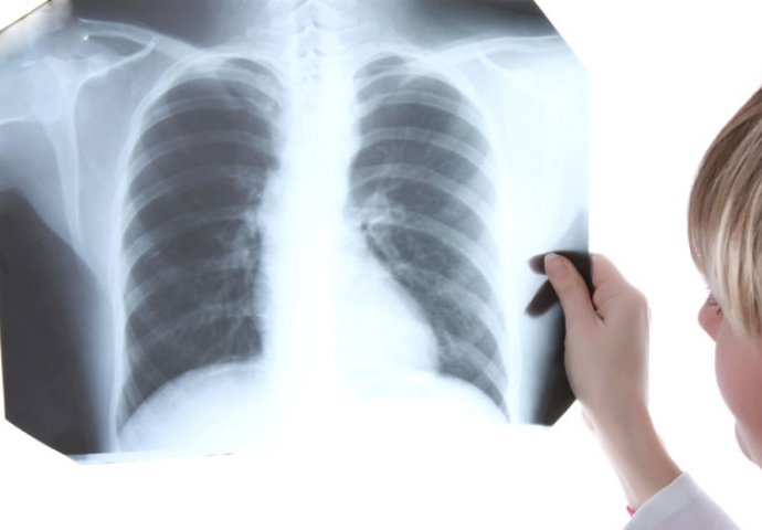 Rak pluća više ne mora biti smrtonosna bolest