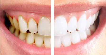 Kako se riješiti žutih zubi? Zagarantovano izbjeljivanje zuba za samo 7 dana