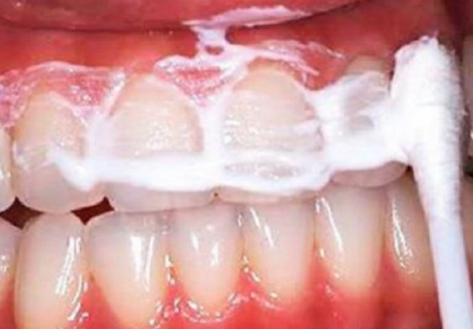 Čuvajte OVU smjesu u ustima 60 sekundi i uklonit će te sav kamenac sa zuba! (RECEPT)