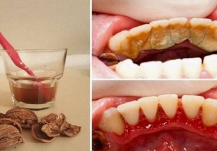 ŽELITE BLISTAV OSMIJEH? Pročitajte kako ukloniti zubni kamenac pomoću jednog sastojka!