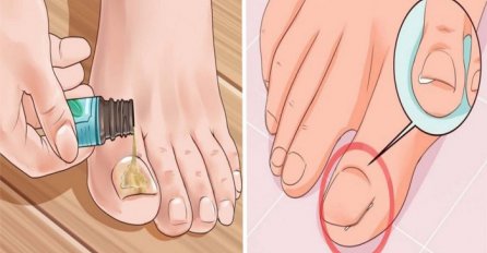 BEZ POSJETE LJEKARU: Evo kako sami možete efikasno i učinkovito ukloniti urasli nokat