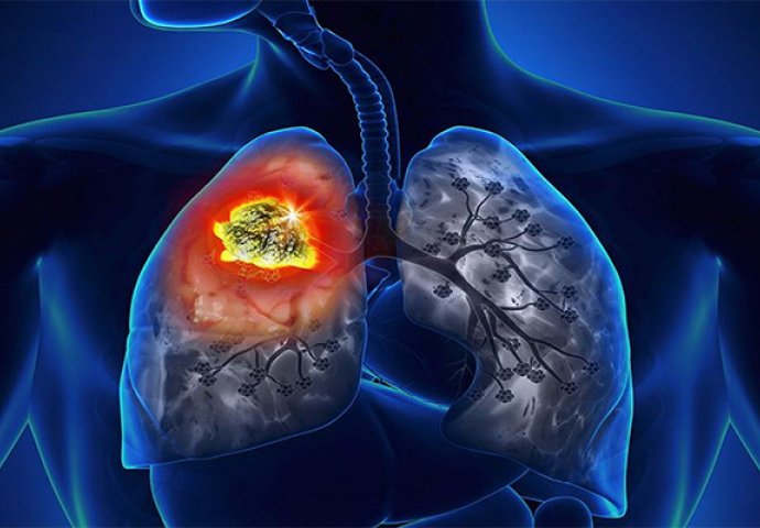 MORATE IH ZNATI: Pogledajte koji su prvi simptomi raka pluća!