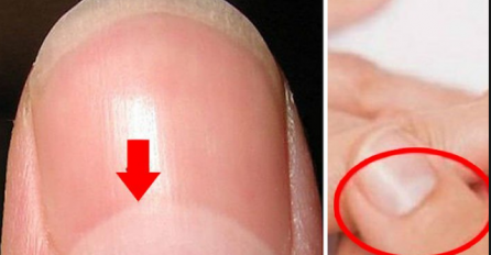Tvoji nokti i tvoje ruke mnogo govore o zdravstvenom stanju organizma: Provjerite da li je sve uredno!