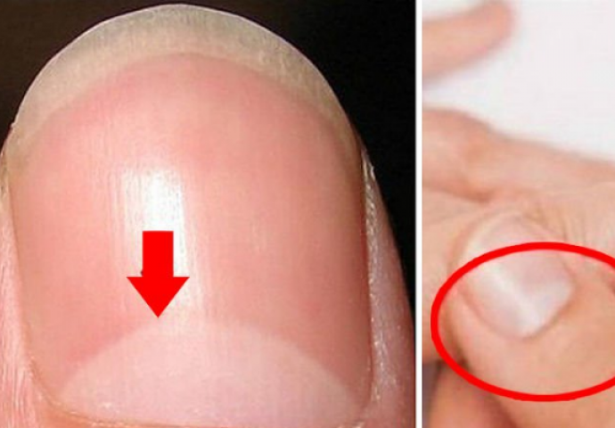 Tvoji nokti i tvoje ruke mnogo govore o zdravstvenom stanju organizma: Provjerite da li je sve uredno!