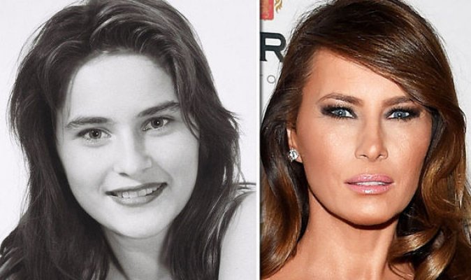 melania-trump-plastic-surgery-before-and-after-756142