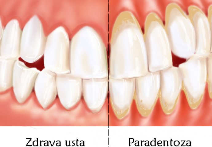 ON JE SAM SEBI IZLIJEČIO PARADONTEZU: Čovjek podijelio svoje iskustvo i RECEPT sa drugima