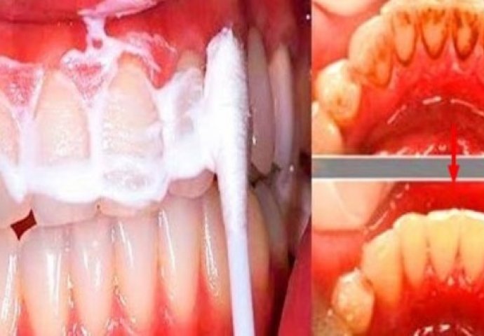 Ovu smjesu čuvajte u ustima samo jednu minutu i uklonit ćete sav kamenac sa zuba! (RECEPT)