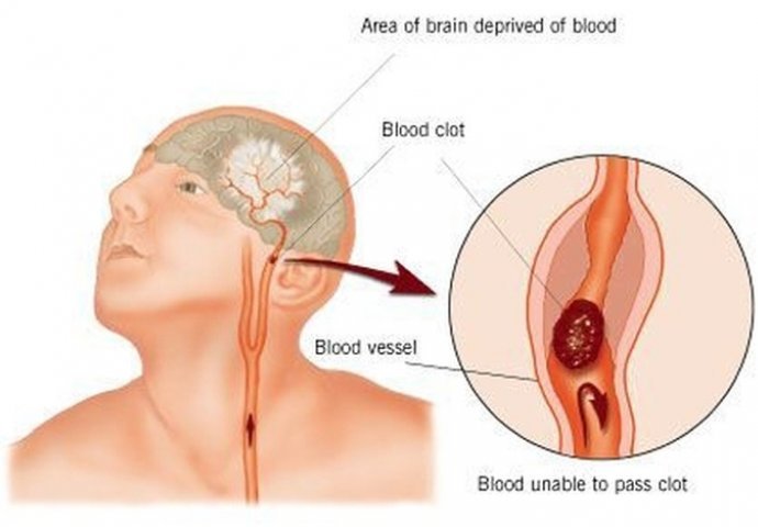 Krvni ugrušak može biti fatalan: Ako primijetite neke od OVIH SIMPTOMA odmah idite u bolnicu!