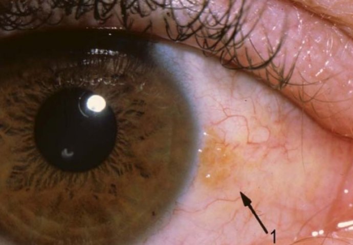 Oči su pokazivač zdravlja: Ako imate mrlje na zjenici, odmah se javite ljekaru