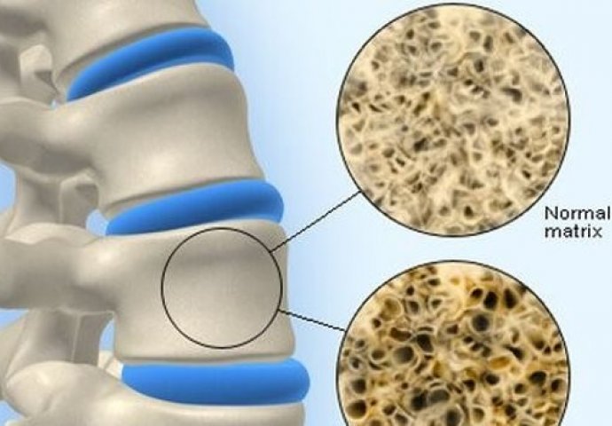 NEMOJTE DOZVOLITI DA VAS LAŽU: Za osteoporozu postoji prirodni lijek