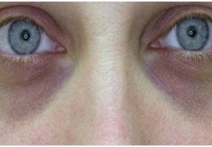 Signali koje vam vaše tijelo šalje: Šta se krije iza velikih i crnih krugova ispod očiju?