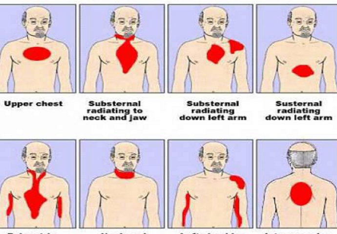 OPREZ: Četiri tjelesna znaka da vam opasno prijeti srčani udar, nisu bezazleni!