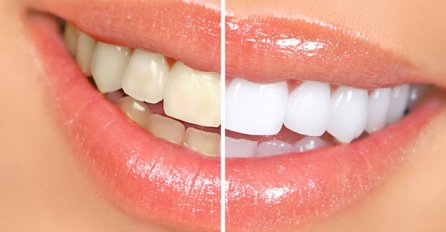 Evo kako da zagarantovano izbijelite zube za manje od 2 minuta!