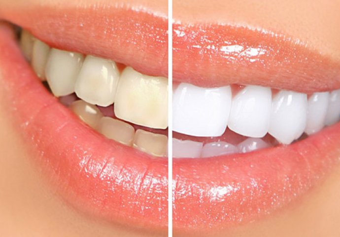 Evo kako da zagarantovano izbijelite zube za manje od 2 minuta!