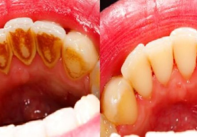 IMATE GA U KUHINJI: Samo jednim sastojkom riješite se zubnog kamenca, plaka i bakterija!