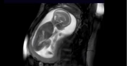 Najjasniji snimak trudnoće: Pogledajte kako se beba igra u stomaku (VIDEO)