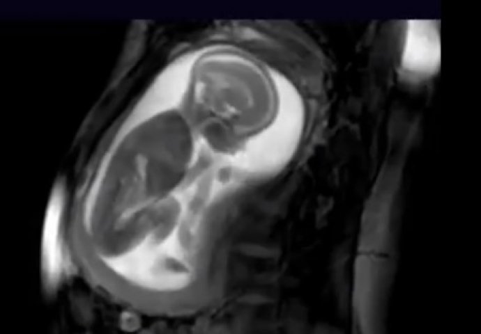 Najjasniji snimak trudnoće: Pogledajte kako se beba igra u stomaku (VIDEO)