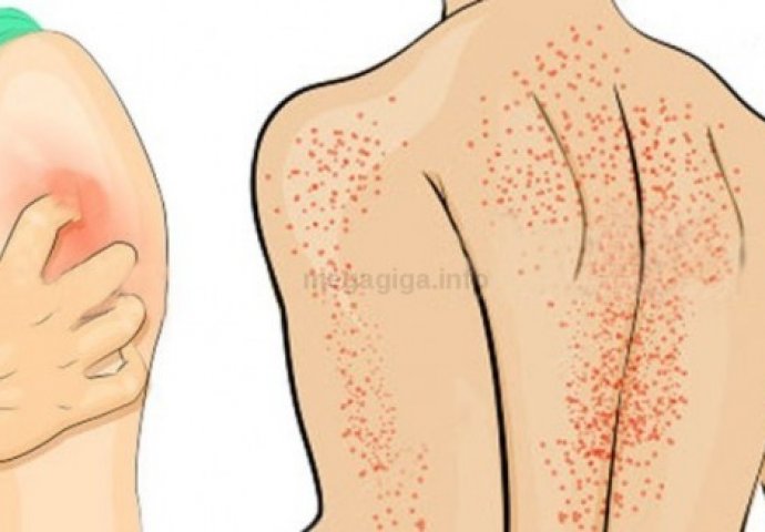 MOŽE VAM SPASITI ŽIVOT: Jedan simptom je ključan za rano otkrivanje raka kože!