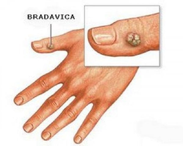 bradavica