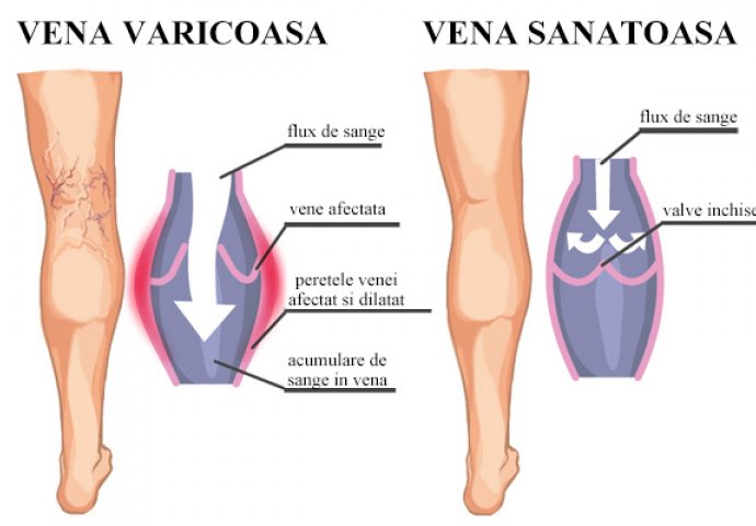 Ovo je najznačajniji savjeti stručnjaka u borbi sa PROŠIRENIM VENAMA