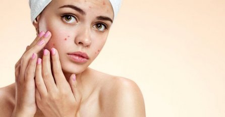 Poznati dermatolog otkrio tajnu: Evo kako da vaše lice  bude čisto, bez bubuljica i to na prirodan način!