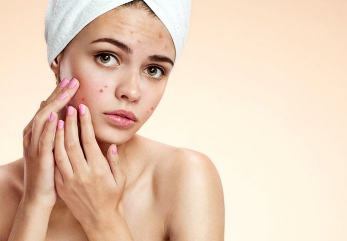 Poznati dermatolog otkrio tajnu: Evo kako da vaše lice  bude čisto, bez bubuljica i to na prirodan način!