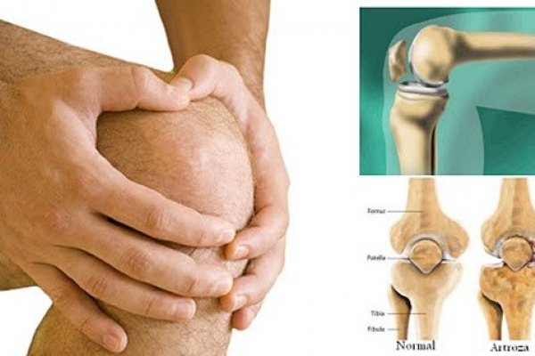 bolna bol i pucketanje u zglobu koljena)