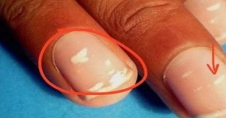 Imate li ove bijele tačkice na vašim noktima? Razlog za to može biti veoma ozbiljan!