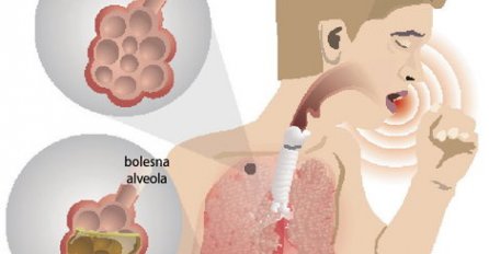 MUČI LI VAS SUHI I DOSADNI KAŠALJ? Probajte ovaj domaći pripravak koji će sigurno riješiti problem!