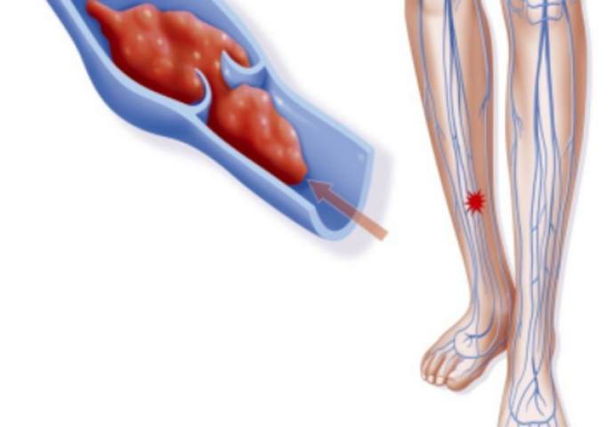 TROMB U NOZI: Osim što uzrokuje bol i oticanje, može utjecati na poremećaj koji često ima SMRTNI ishod