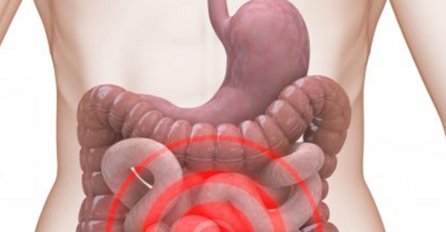 OVO JE 5 ZNAKOVA KARCINOMA DEBELOG CRIJEVA: Zadnji je NAJVAŽNIJI i nikad ga ne ignorišite!