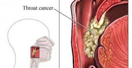 Rak grla - koliko se često javlja i kod koga?