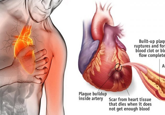 Mjesec dana prije srčanog udara tijelo će vas UPOZORITI: Ako primijetite ove simptome NE IGNORIŠITE IH!