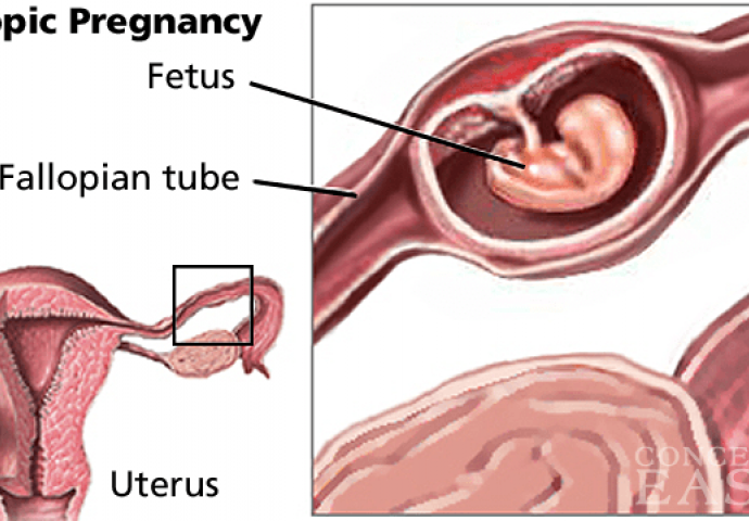 Šta je potrebno da znate o EKTOPIČNOJ - VANMATERIČNOJ trudnoći?