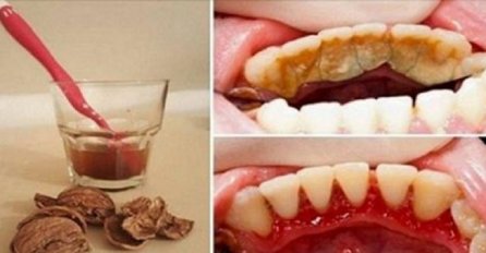 BEZ ODLASKA STOMATOLOGU! Pogledajte kako ćete ukloniti kamenac s vaših zuba SASTOJCIMA KOJE IMATE U KUHINJI! (PRIRODNO)