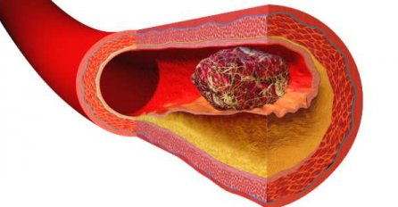 BORA DRLJAČA PREMINUO OD VENSKE TROMBOZE, A OVO SU SIMPTOMI: Ako primijetite ODMAH DOKTORU