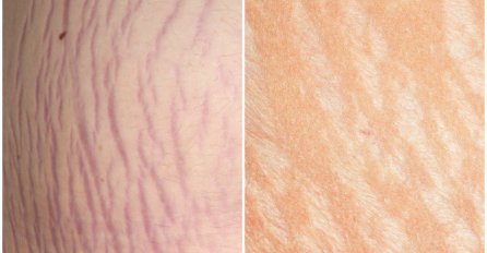 Jedna biljka kao skalpelom briše sve ožiljke, opekotine i strije, a koža se podmlađuje